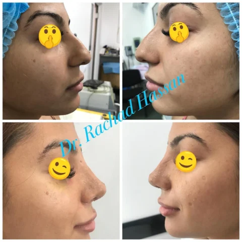 Caz rinoplastie 048