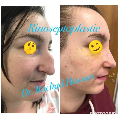 Caz rinoplastie 049