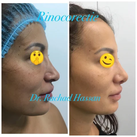 Caz rinoplastie 050