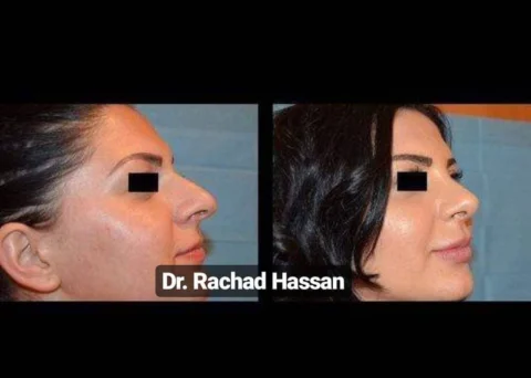 Caz rinoplastie 052