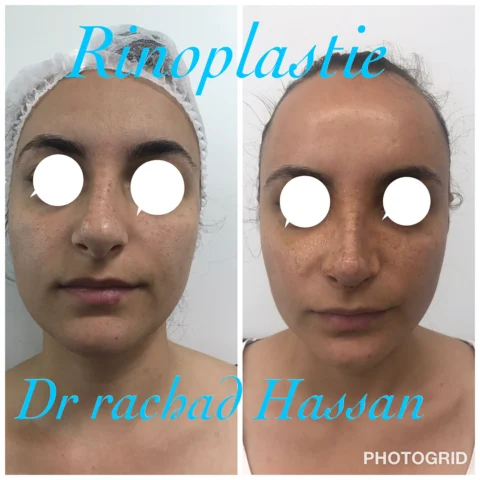 Caz rinoplastie 023