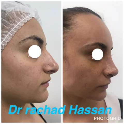 Caz rinoplastie 024