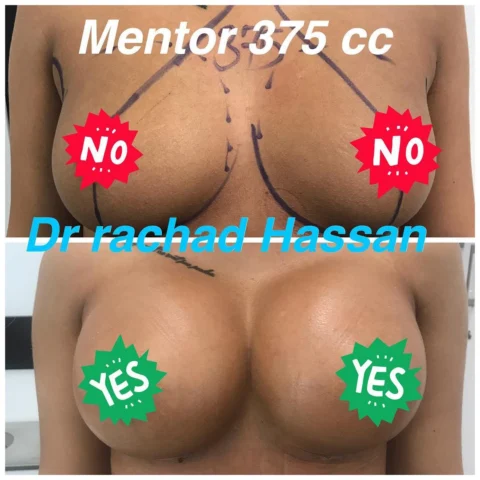 Caz implant mamar 105