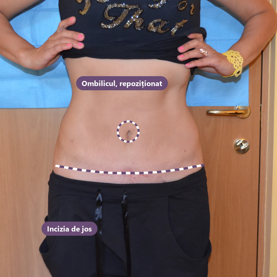 Incizia abdominoplastiei și ombilicul repoziționat, marcate pe fotografia unei paciente