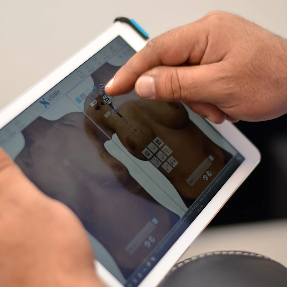 Scanarea 3D pe tabletă, la consultația pentru abdominoplastie