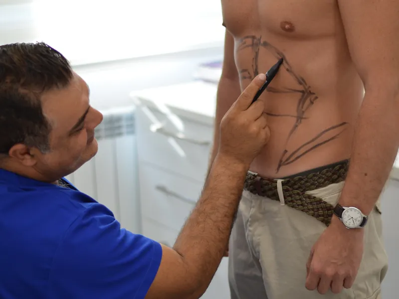 Dr. Rachad marchează zonele de tratat înainte de liposucție