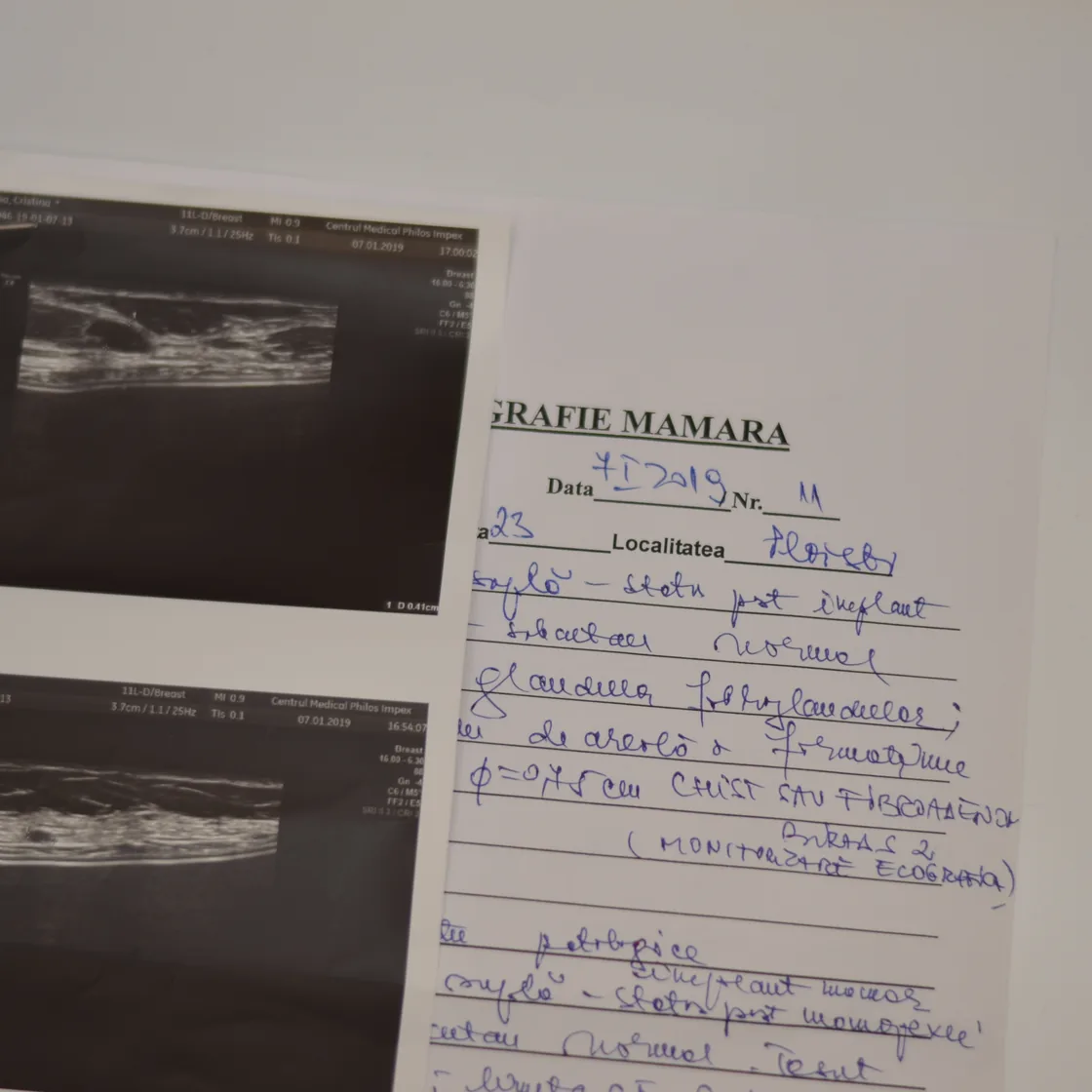 Ecografie mamară, analiză obligatorie înainte de operația de implant mamar