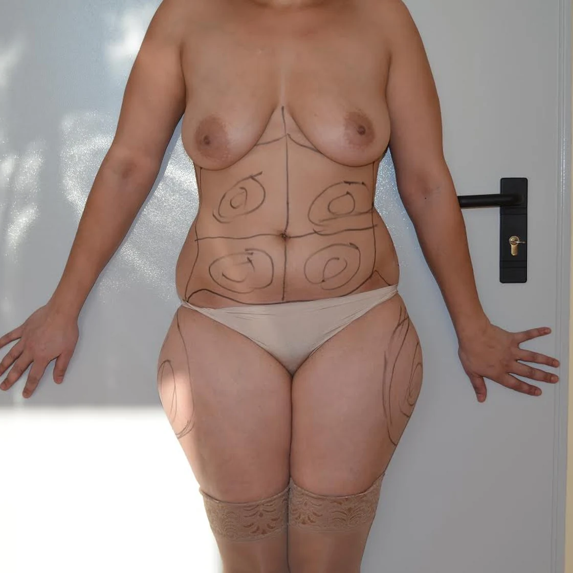 Pacientă cu zonele de liposucție marcate pe abdomen și coapse, înainte de operație