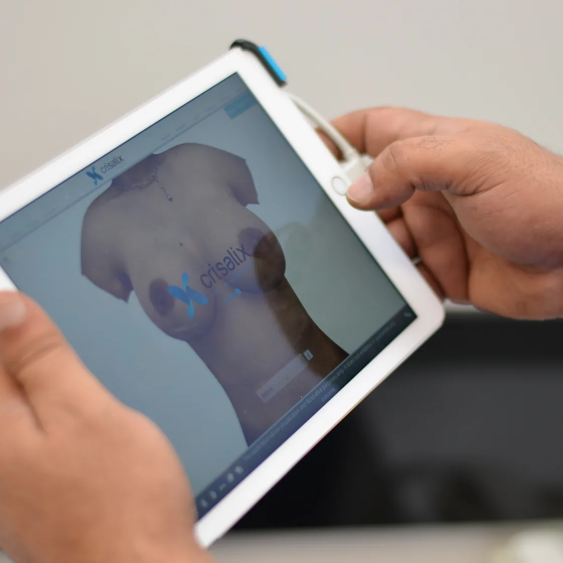 Simulare 3D pe tabletă pentru alegerea mărimii implantului mamar